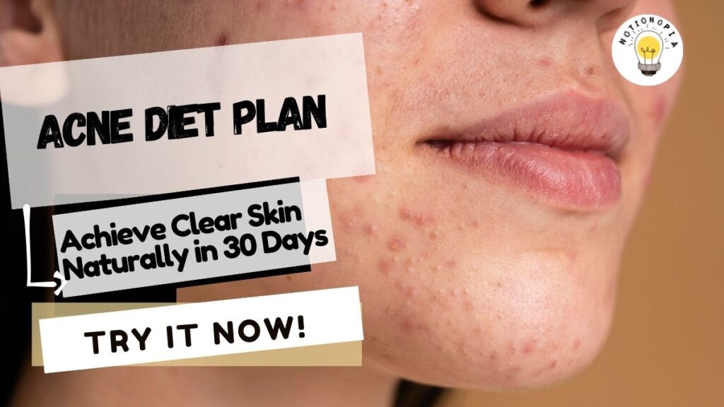 Close-up of acne-prone skin with text promoting an acne diet plan for clearer skin in 30 days.